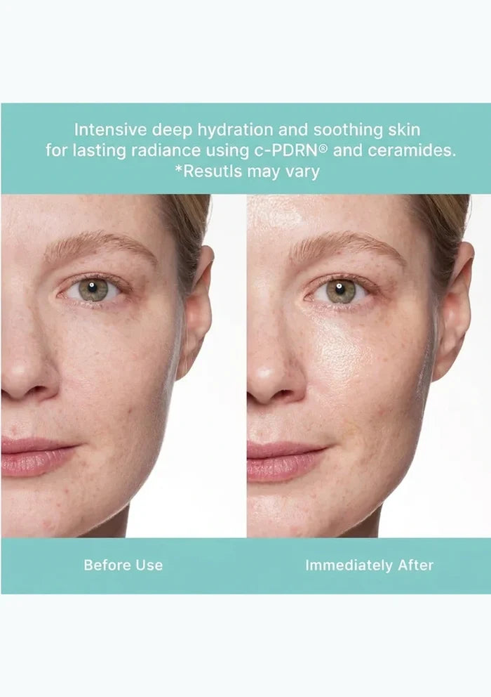 REJURAN Turnover Mask before and after skin appearance comparison